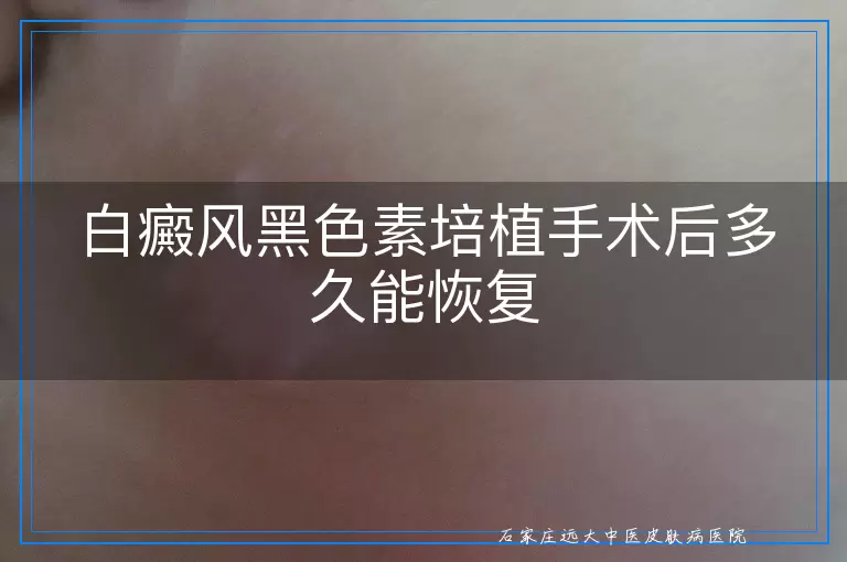 白癜风黑色素培植手术后多久能恢复