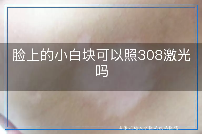 脸上的小白块可以照308激光吗