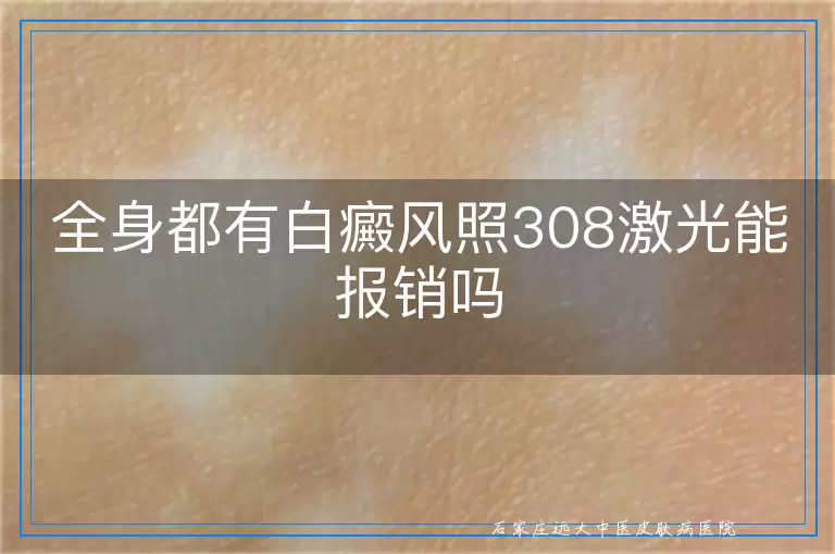 全身都有白癜风照308激光能报销吗