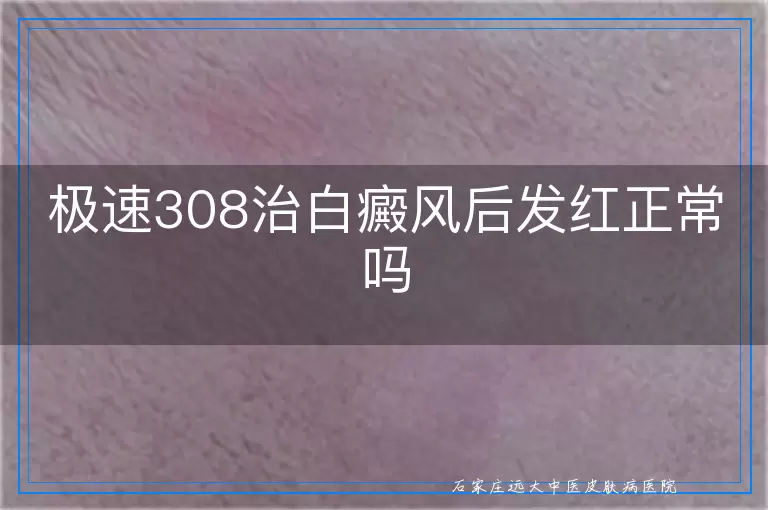 极速308治白癜风后发红正常吗