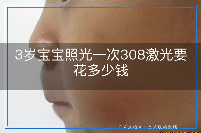 3岁宝宝照光一次308激光要花多少钱