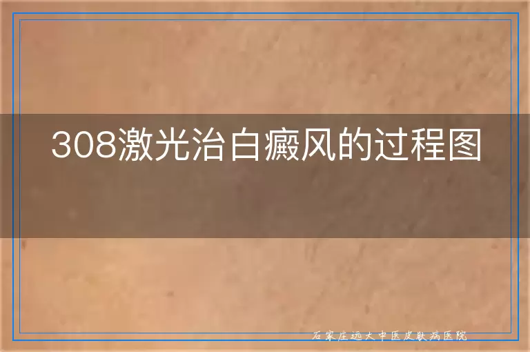 308激光治白癜风的过程图