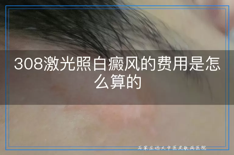 308激光照白癜风的费用是怎么算的