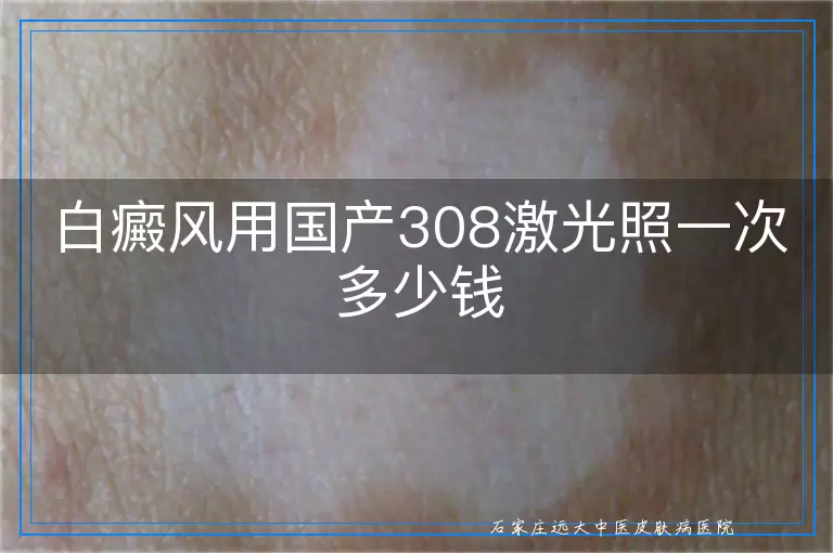 白癜风用国产308激光照一次多少钱