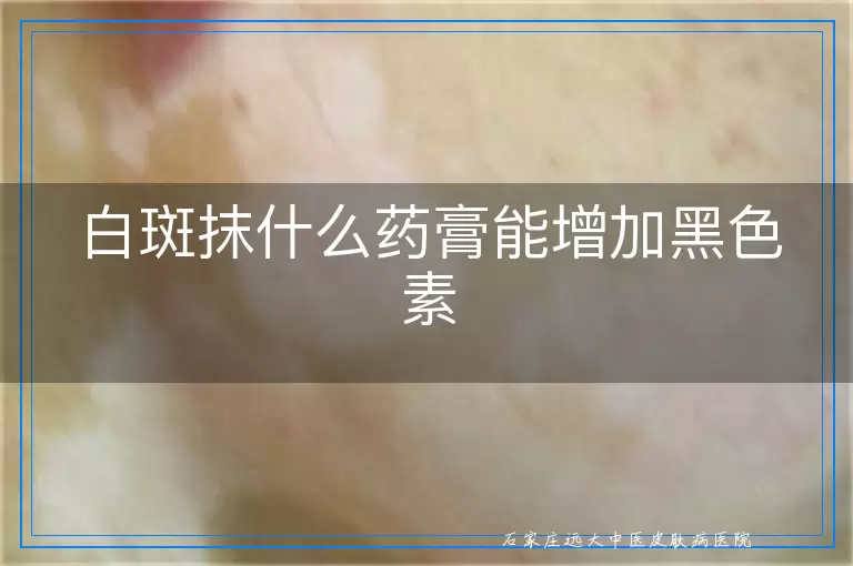 白斑抹什么药膏能增加黑色素