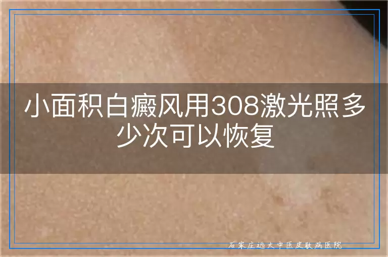 小面积白癜风用308激光照多少次可以恢复