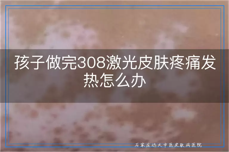 孩子做完308激光皮肤疼痛发热怎么办