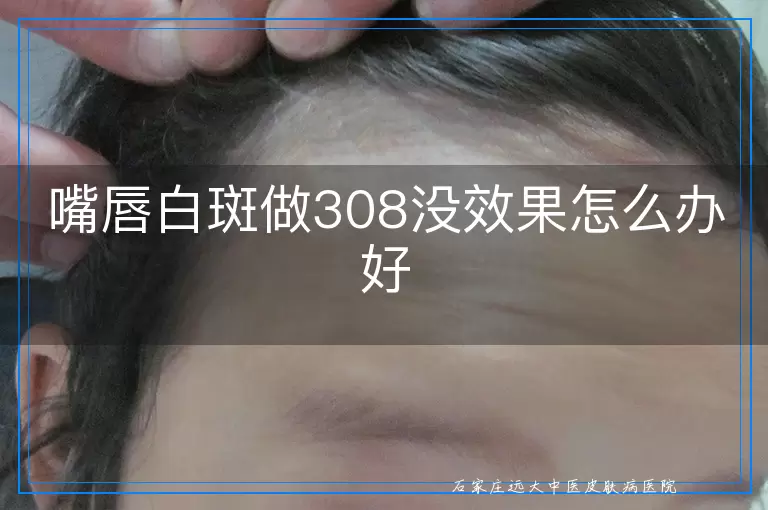 嘴唇白斑做308没效果怎么办好