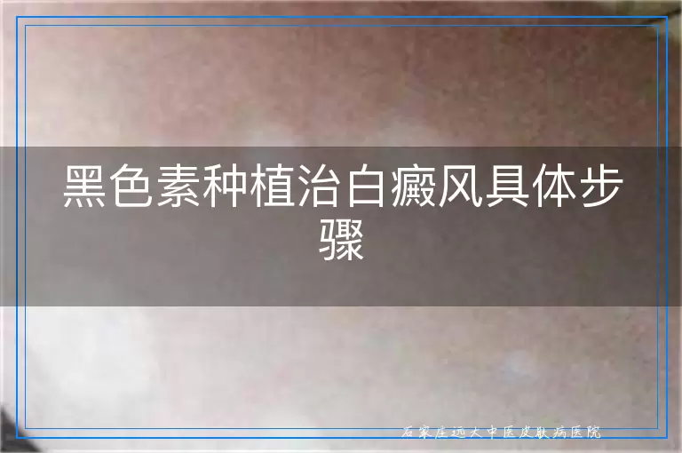 黑色素种植治白癜风具体步骤