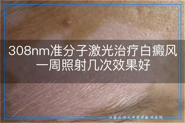 308nm准分子激光治疗白癜风一周照射几次效果好