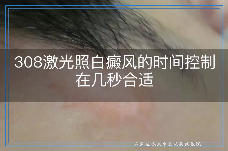 308激光照白癜风的时间控制在几秒合适