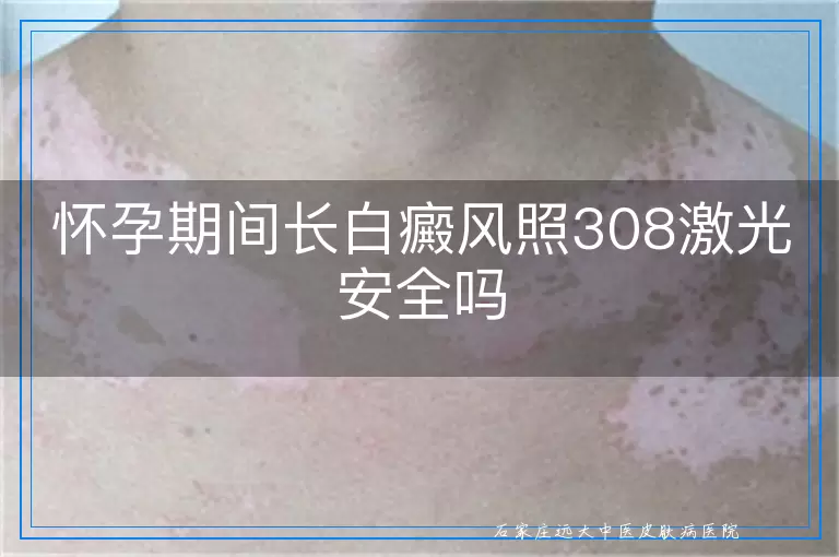 怀孕期间长白癜风照308激光安全吗