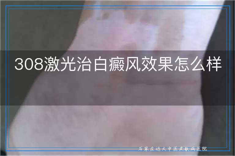 308激光治白癜风效果怎么样