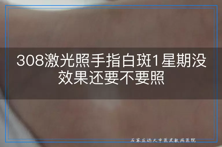 308激光照手指白斑1星期没效果还要不要照