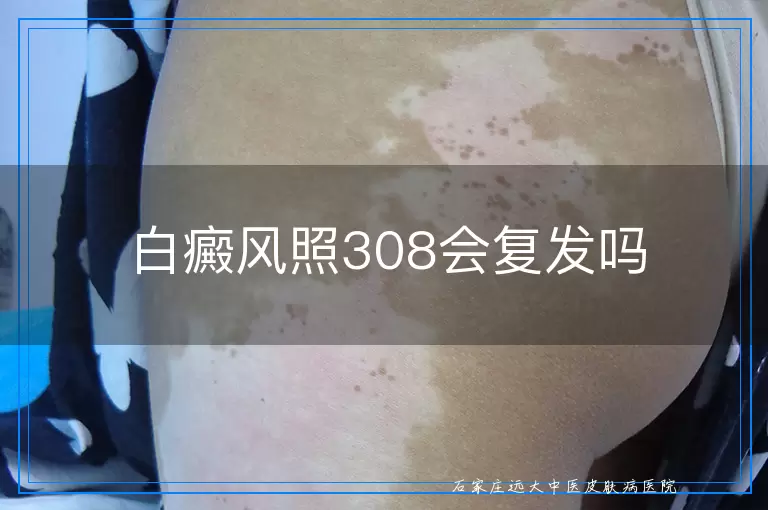 白癜风照308会复发吗