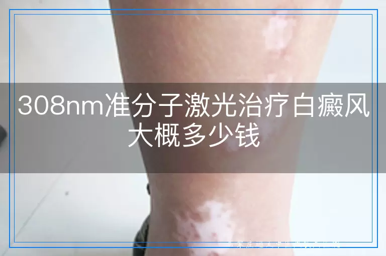 308nm准分子激光治疗白癜风大概多少钱