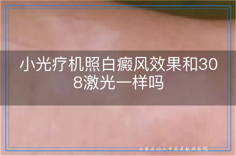 小光疗机照白癜风效果和308激光一样吗