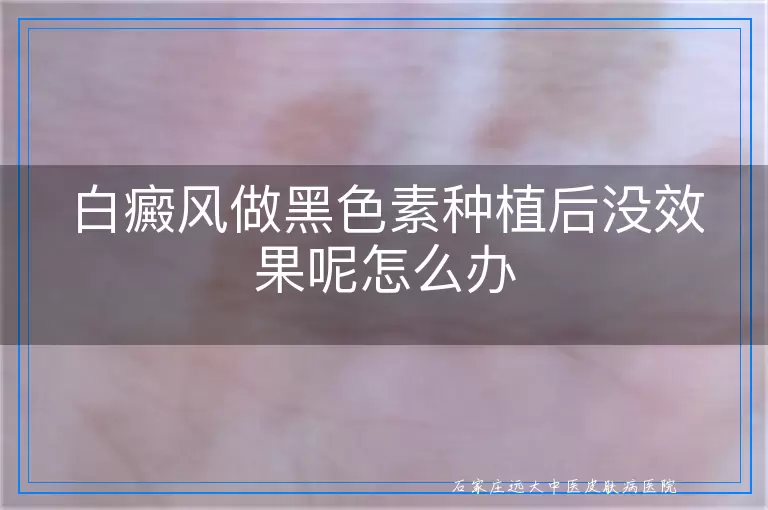 白癜风做黑色素种植后没效果呢怎么办