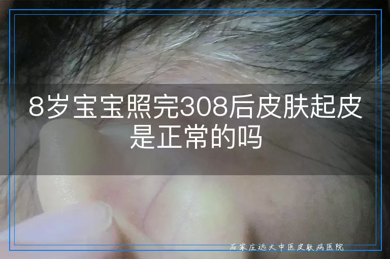 8岁宝宝照完308后皮肤起皮是正常的吗