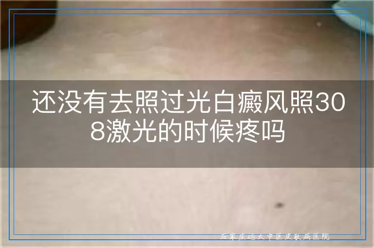 还没有去照过光白癜风照308激光的时候疼吗