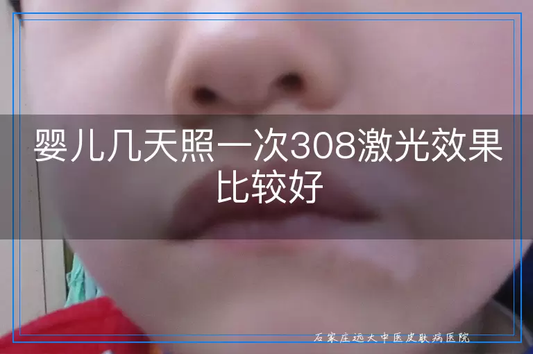 婴儿几天照一次308激光效果比较好