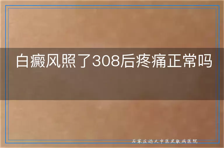 白癜风照了308后疼痛正常吗