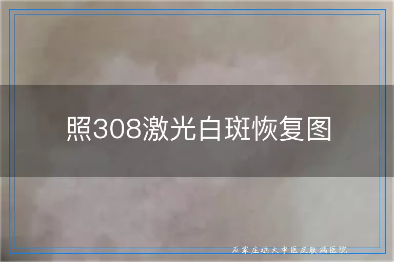 照308激光白斑恢复图