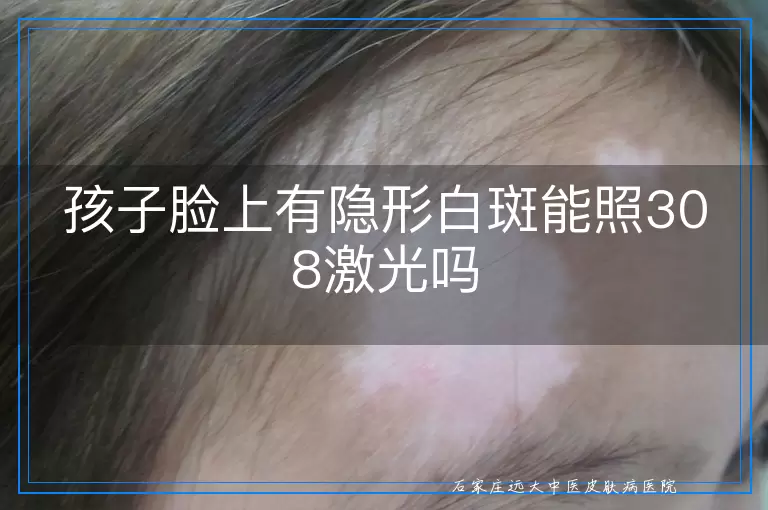 孩子脸上有隐形白斑能照308激光吗