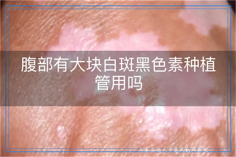 腹部有大块白斑黑色素种植管用吗