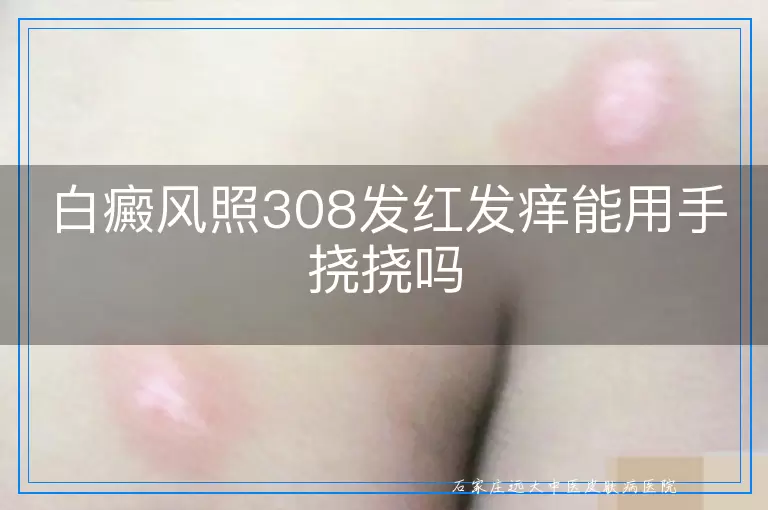 白癜风照308发红发痒能用手挠挠吗