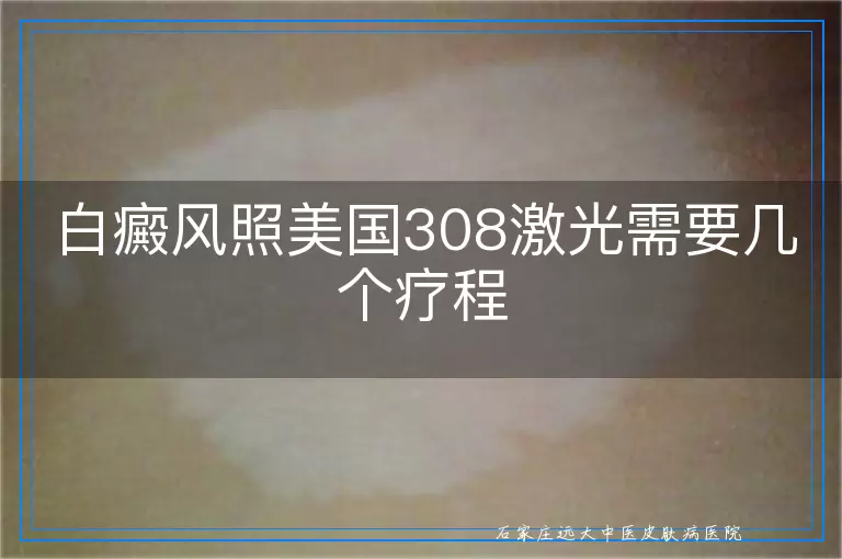 白癜风照美国308激光需要几个疗程
