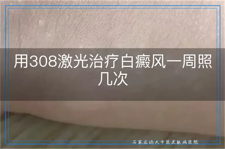 用308激光治疗白癜风一周照几次