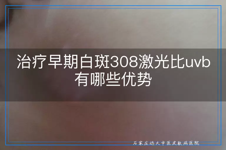 治疗早期白斑308激光比uvb有哪些优势