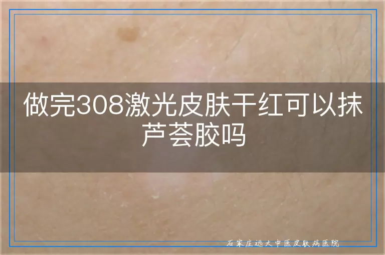 做完308激光皮肤干红可以抹芦荟胶吗