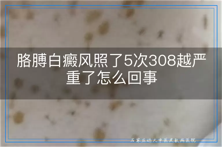 胳膊白癜风照了5次308越严重了怎么回事