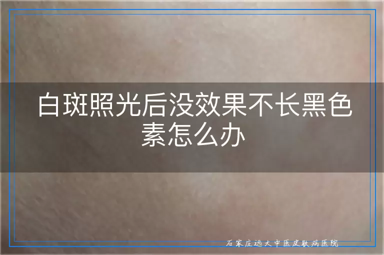 白斑照光后没效果不长黑色素怎么办