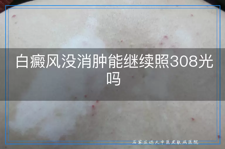 白癜风没消肿能继续照308光吗