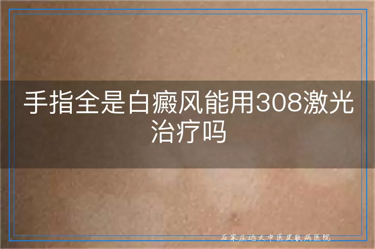 手指全是白癜风能用308激光治疗吗