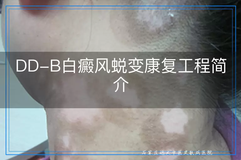 DD-B白癜风蜕变康复工程简介