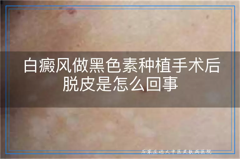 白癜风做黑色素种植手术后脱皮是怎么回事