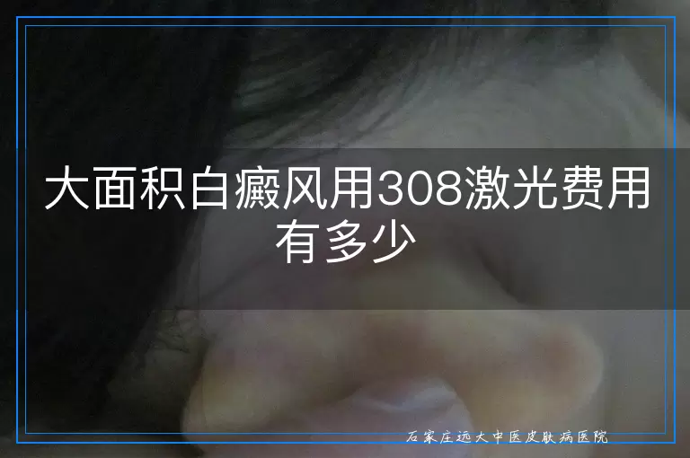 大面积白癜风用308激光费用有多少