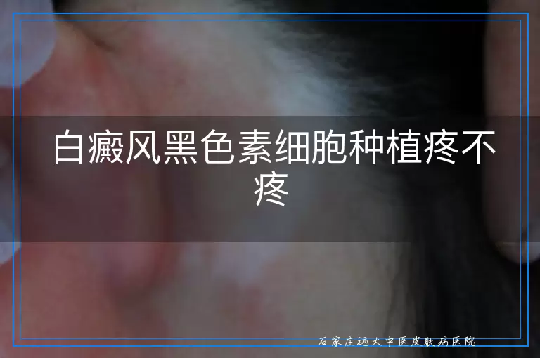 白癜风黑色素细胞种植疼不疼