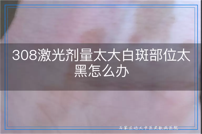 308激光剂量太大白斑部位太黑怎么办
