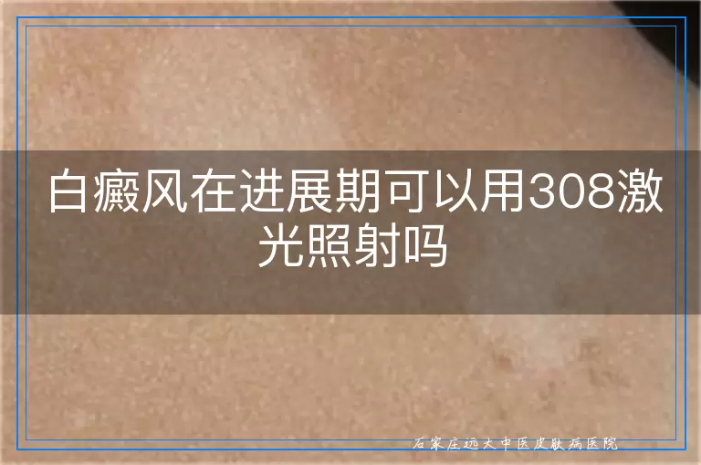 白癜风在进展期可以用308激光照射吗