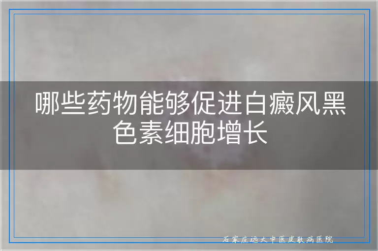 哪些药物能够促进白癜风黑色素细胞增长