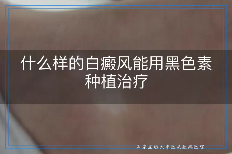什么样的白癜风能用黑色素种植治疗