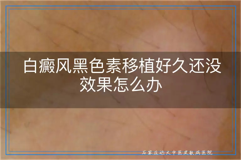 白癜风黑色素移植好久还没效果怎么办