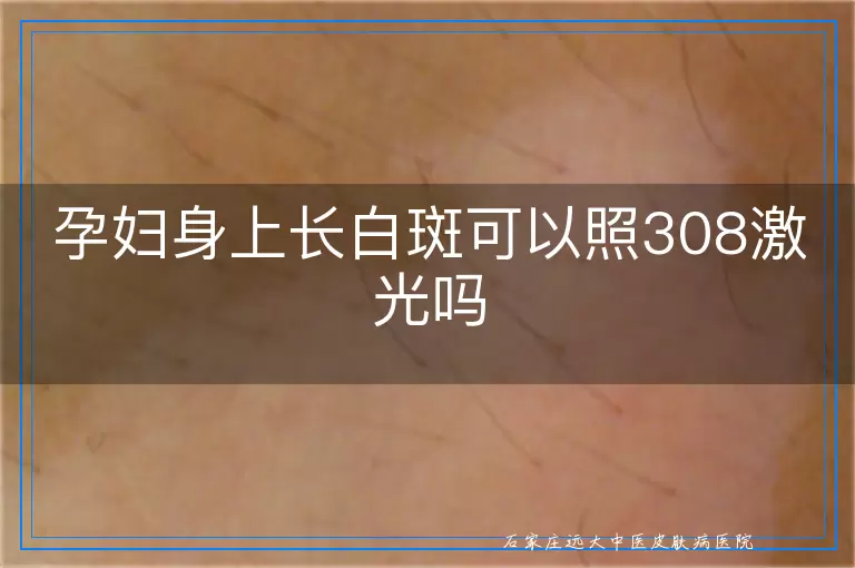 孕妇身上长白斑可以照308激光吗