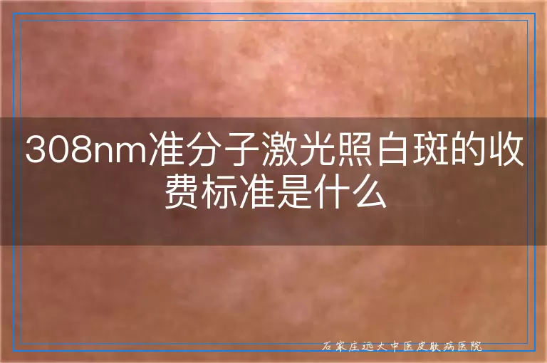 308nm准分子激光照白斑的收费标准是什么
