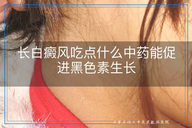 长白癜风吃点什么中药能促进黑色素生长